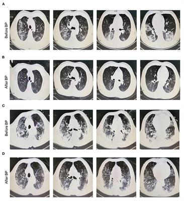 Blood Purification in <mark class="highlighted">Severe and Critical</mark> COVID-19 Patients: A Case Series of 5 Patients